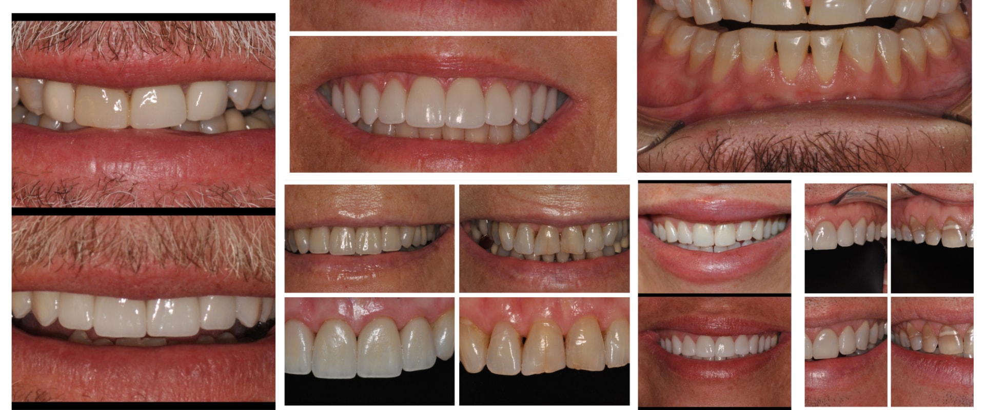 Complete Transformation of Smile Appearance: How a Smile Makeover Can Benefit You