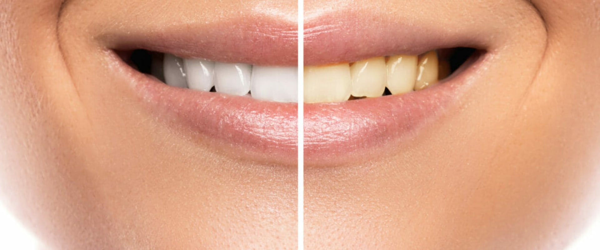 Boost Your Confidence: The Benefits of Teeth Whitening