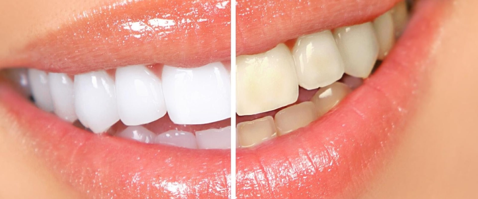 The Importance of Touch-Up Treatments for Maintaining a Bright White Smile