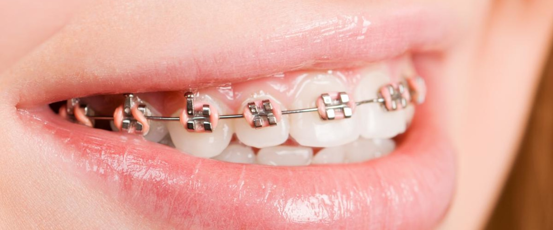 A Comprehensive Look at Traditional Metal Braces