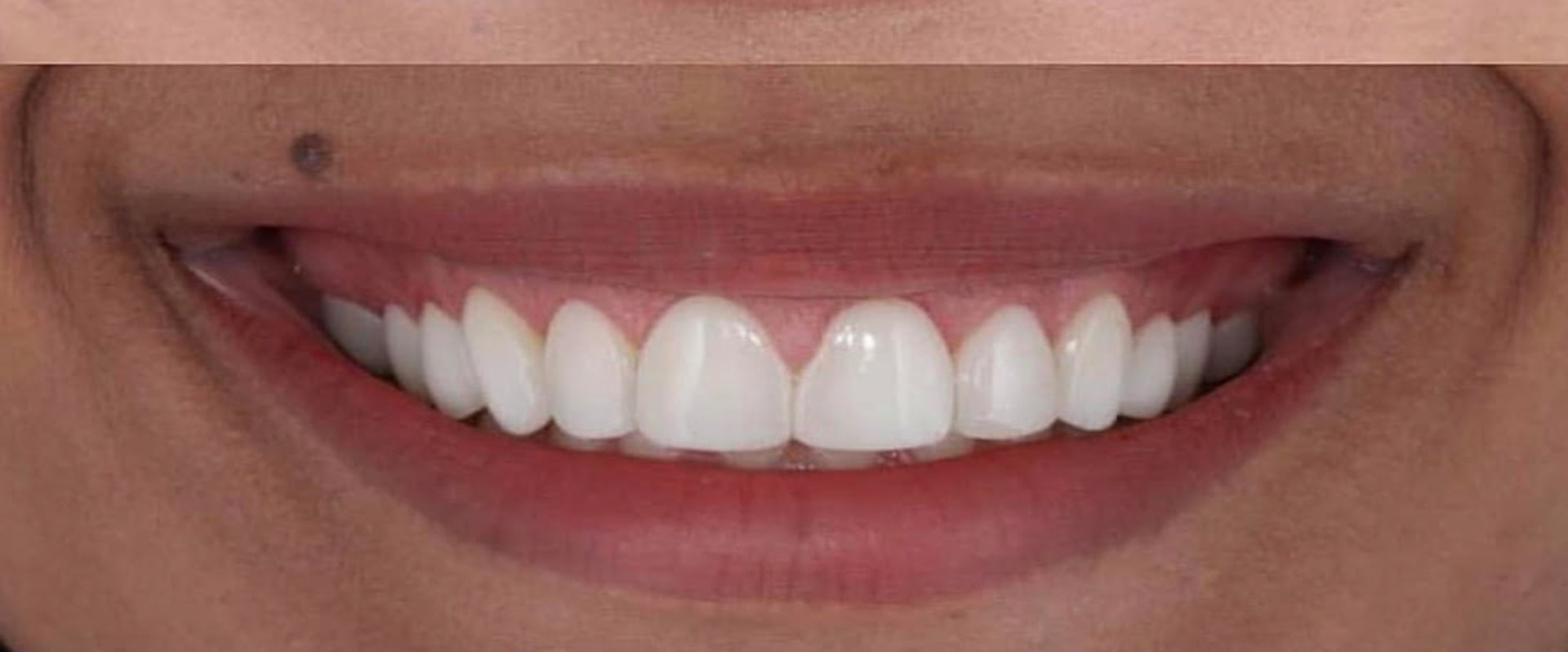 Understanding the Procedure and Recovery for Gum Reshaping