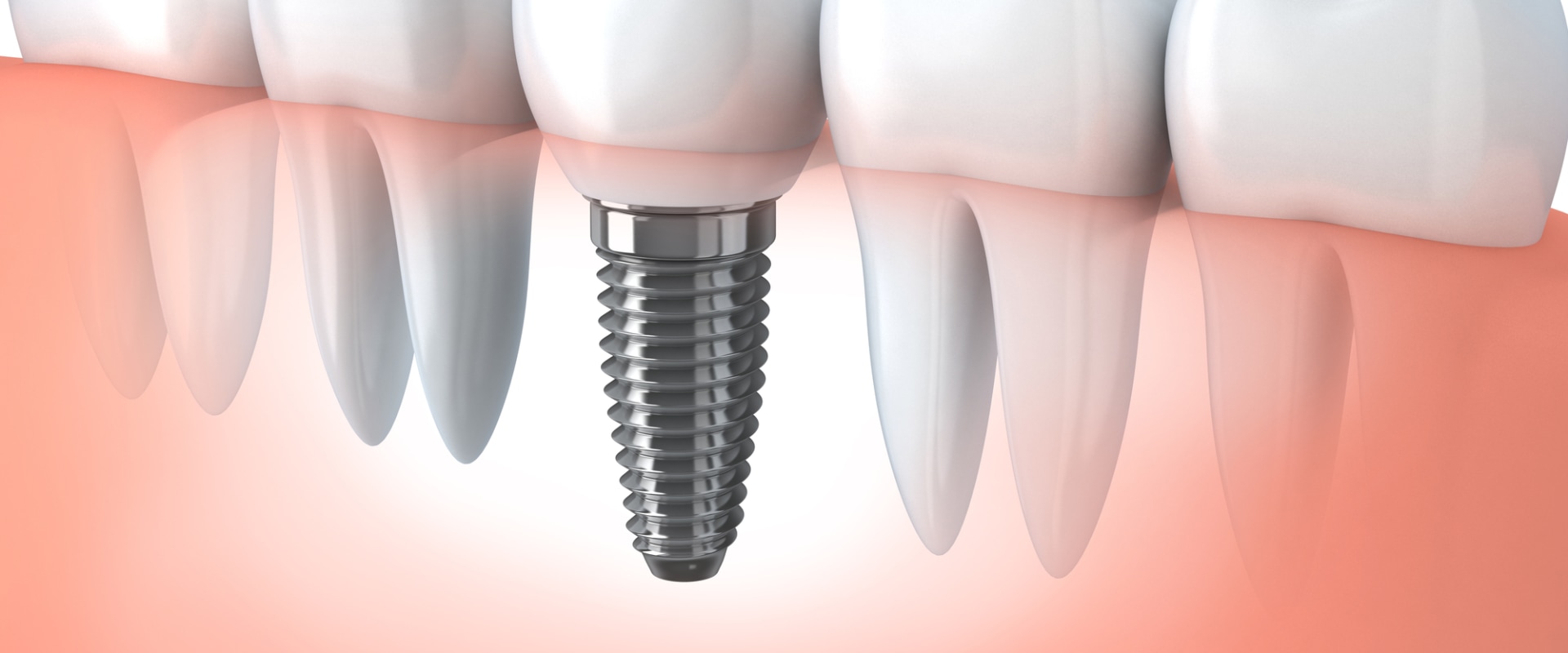Understanding the Risks of Dental Implants
