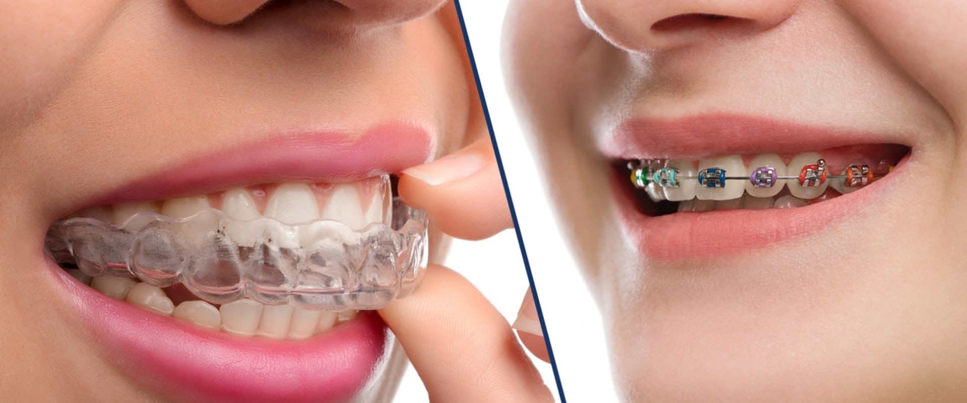All You Need to Know About Clear Aligners (Invisalign)
