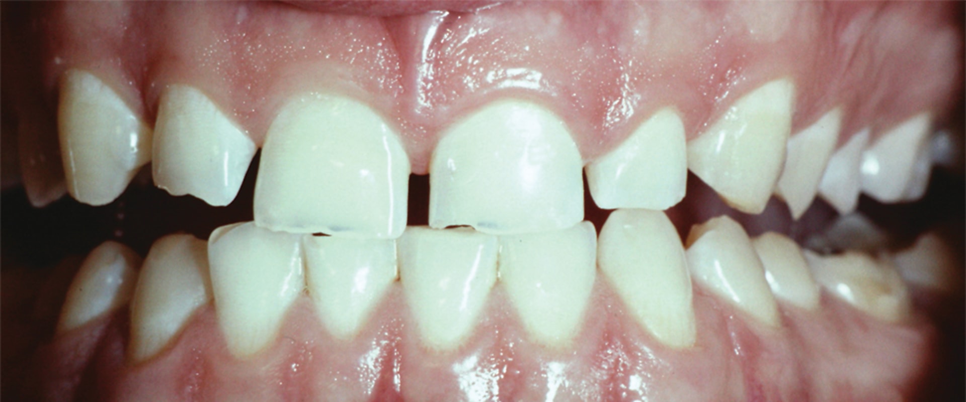 Understanding the Potential for Damage to Natural Teeth