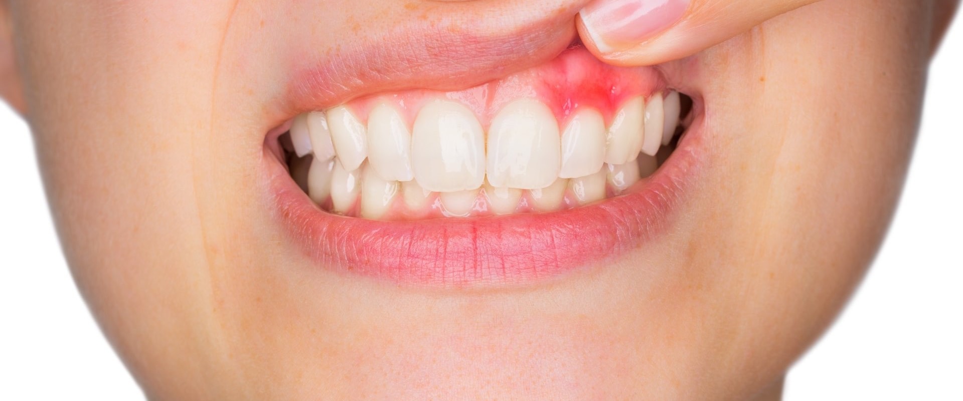 Understanding Gum Disease and Its Impact on Oral Health