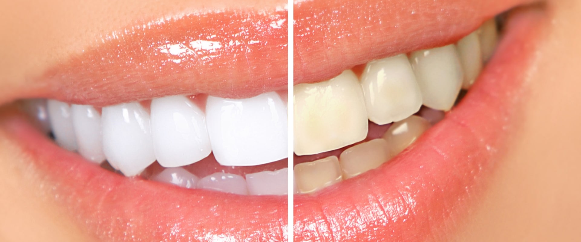 Discover the Secret to a Brighter Smile: In-Office Professional Teeth Whitening