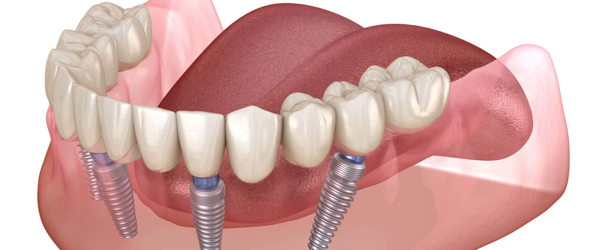Improved Appearance and Self-Esteem: The Benefits of Dental Implants