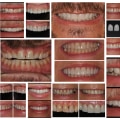 Complete Transformation of Smile Appearance: How a Smile Makeover Can Benefit You