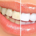 The Importance of Touch-Up Treatments for Maintaining a Bright White Smile