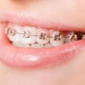 A Comprehensive Look at Traditional Metal Braces