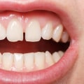 Dental Bonding: An Affordable Solution for a Beautiful Smile