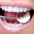 Lingual Braces: A Comprehensive Guide to Teeth Straightening