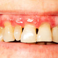 Long-Term Solutions for Tooth Loss: Everything You Need to Know