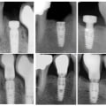 Understanding Implant Failure: Risks and Considerations