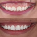 The Pros and Cons of Teeth Reshaping and Contouring