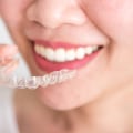 Reduced Risk of Dental Problems: The Benefits of Teeth Straightening