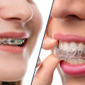 All You Need to Know About Clear Aligners (Invisalign)