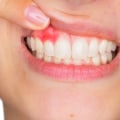 Understanding Gum Disease and Its Impact on Oral Health