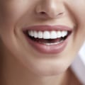 Understanding Composite Veneers: Everything You Need to Know