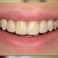 Exploring Alternatives to Teeth Reshaping and Contouring
