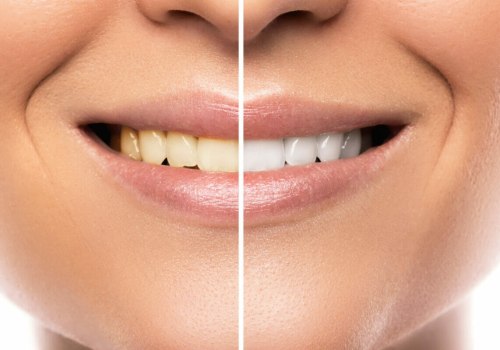 Boost Your Confidence: The Benefits of Teeth Whitening
