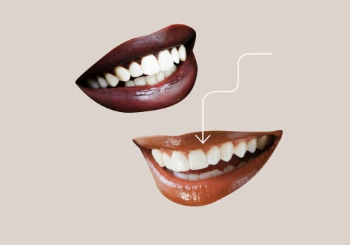 Understanding Irreversible Processes for Veneers: Risks and Considerations