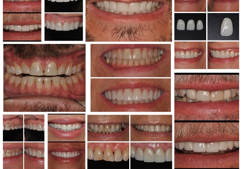 Veneers vs. Crowns: Understanding the Difference for Your Smile Makeover