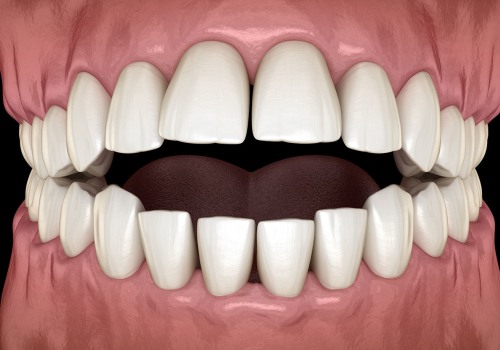 How Correcting Your Bite Can Improve Your Oral Health