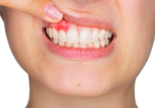 Preventing Tooth Decay and Gum Disease: Tips for a Healthy Smile