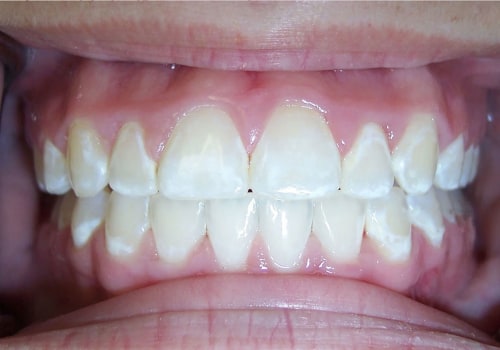 Understanding Uneven Results in Teeth Whitening