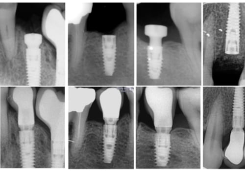 Understanding Implant Failure: Risks and Considerations