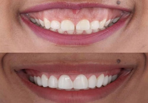 Understanding the Procedure and Recovery for Gum Reshaping