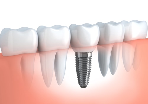 Understanding the Risks of Dental Implants