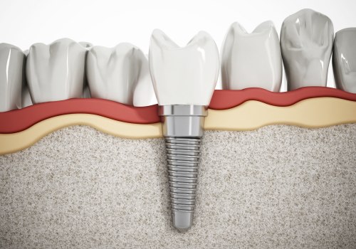 Avoiding Habits That Can Damage Implants: Tips and Advice for Dental Implant Aftercare
