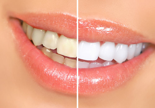 Discover the Secret to a Brighter Smile: In-Office Professional Teeth Whitening