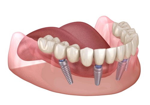 Improved Appearance and Self-Esteem: The Benefits of Dental Implants