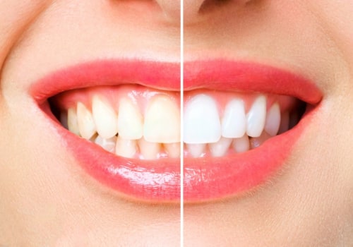 Natural Teeth Whitening Methods